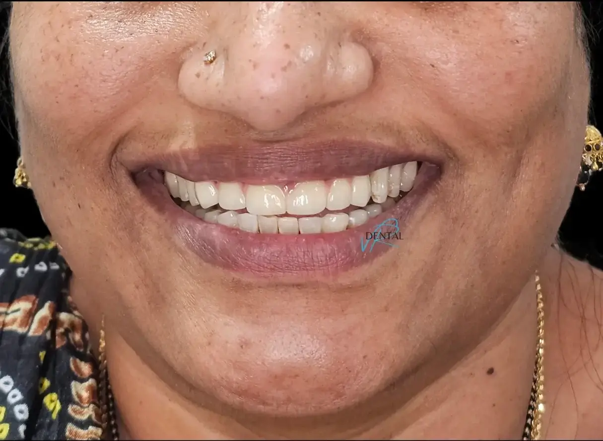 Smile after digital design and porcelain veneer restoration