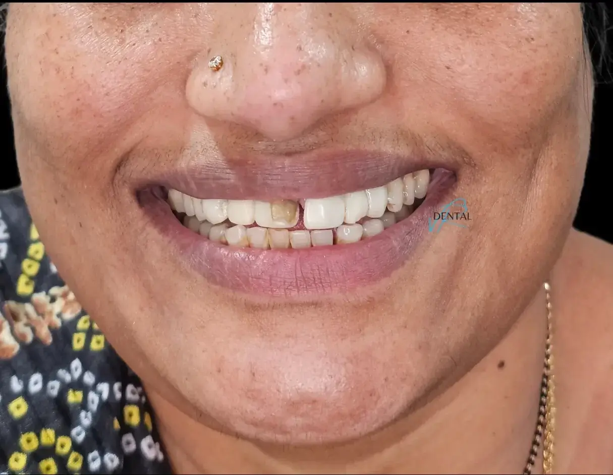 Smile before treatment showing discoloration and misalignment